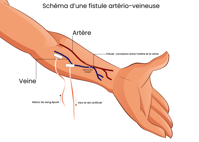 Schéma-dune-fistule-artério-veineuse
